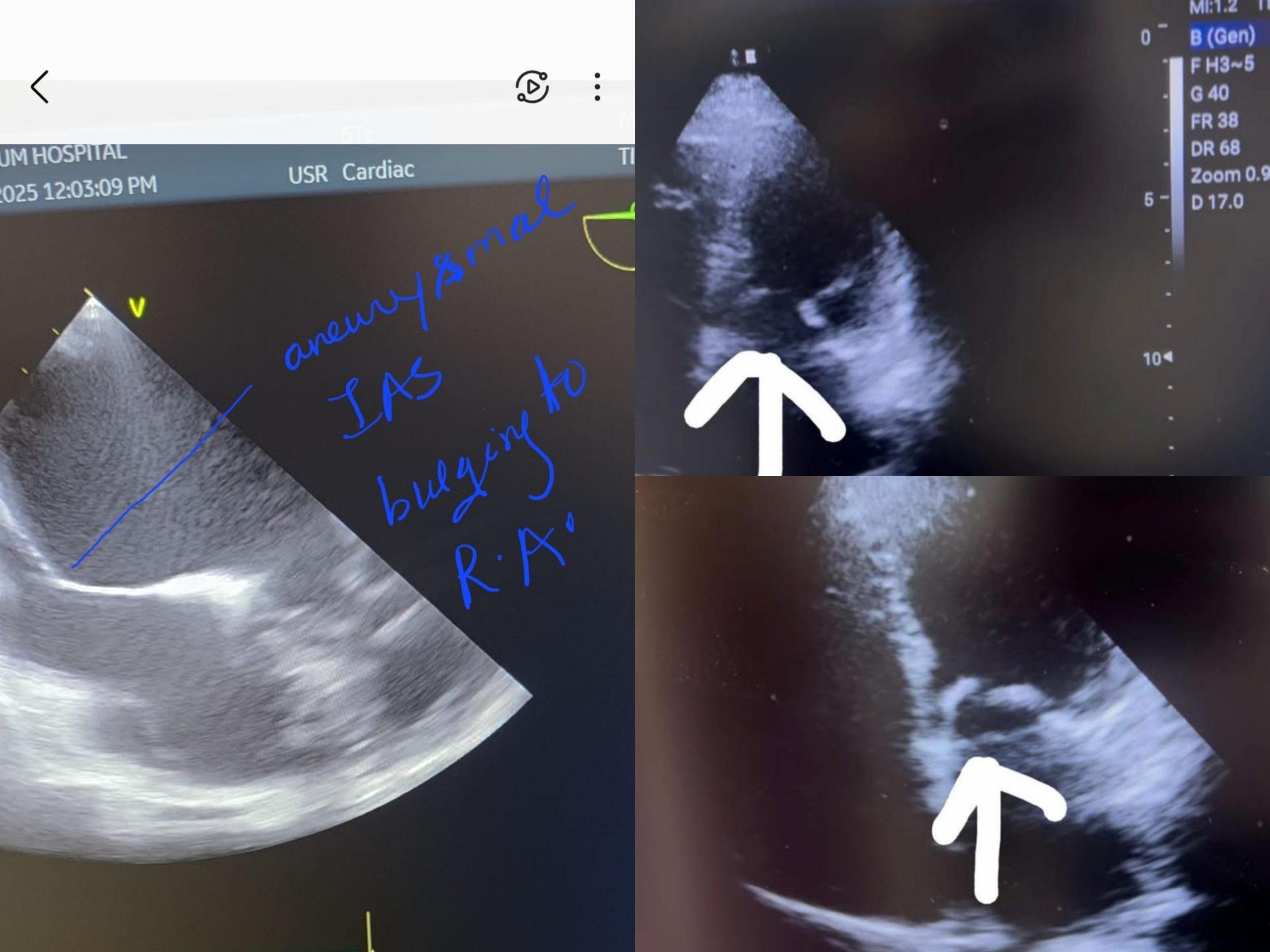 Successful Balloon Mitral Valvotomy Following Cardiac Tamponade in a Patient with Severe Mitral Stenosis and Aneurysmal Interatrial Septum