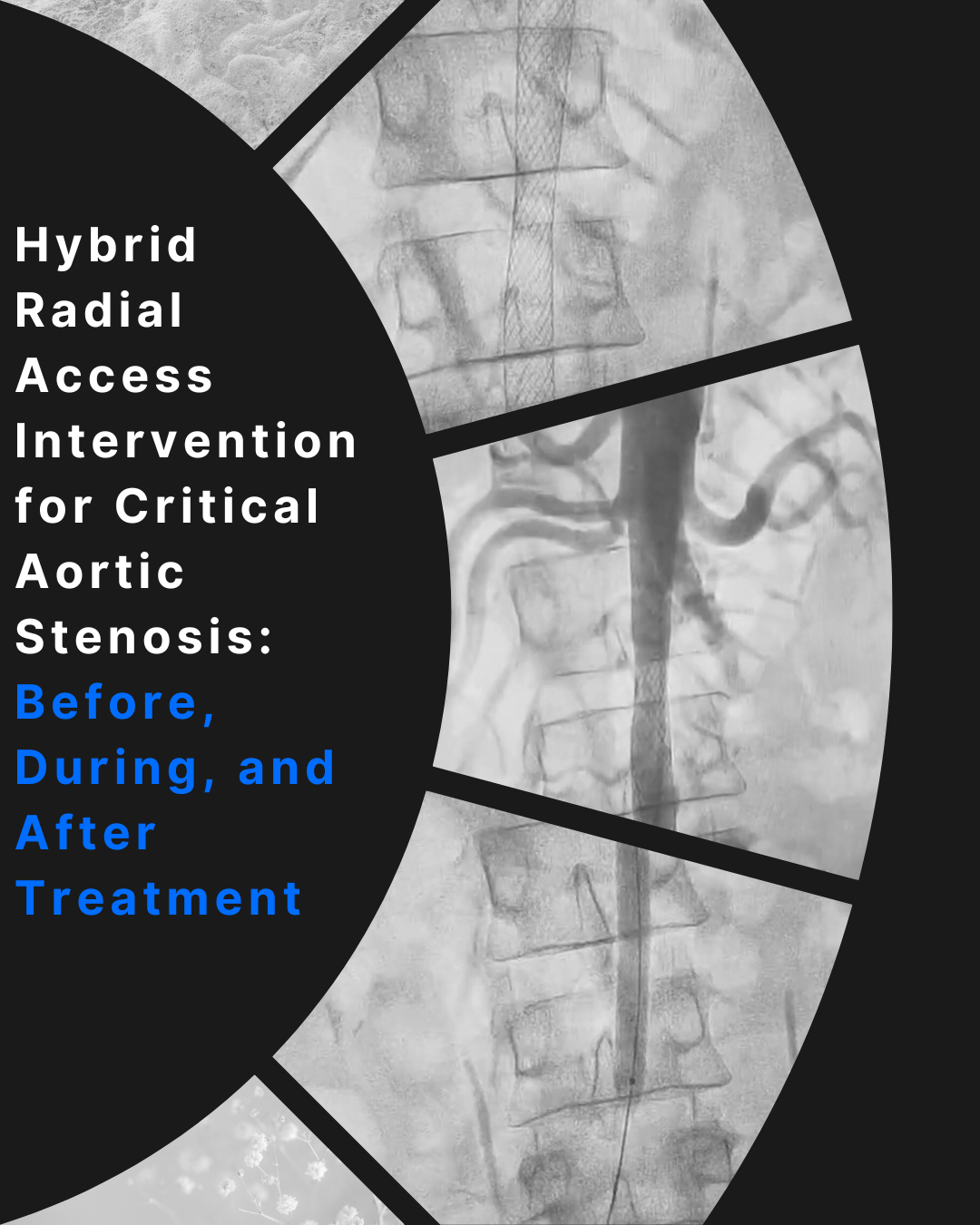 Radial-to-Femoral Hybrid Approach for Limb Salvage in Critical Infrarenal Aortic Stenosis