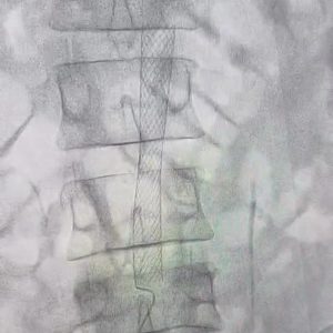 Angiography showing critical infrarenal aortic stenosis with measurements 8.2mm diameter before radial femoral hybrid intervention